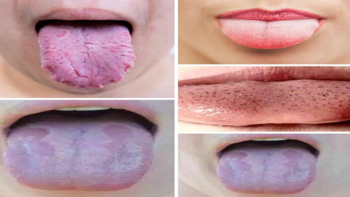 10 health secrets and danger signs your tongue can reveal