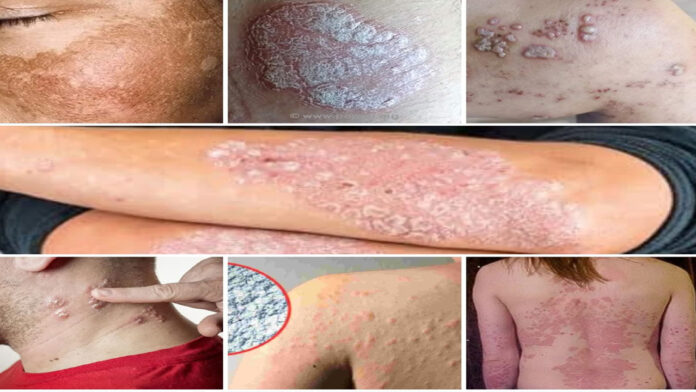 Ayurvedic skin care medicine