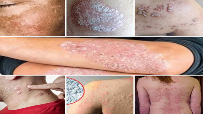 Two types of treatment are essential for permanent relief from any skin problem.