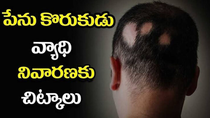 Three amazing tips to get rid of the lice problem...